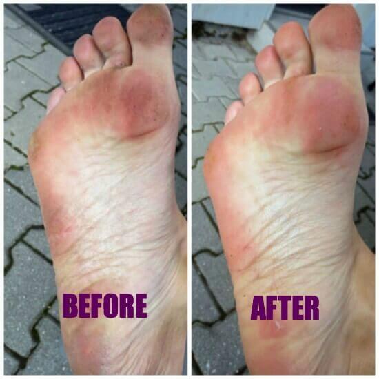 before after foot scrub collage
